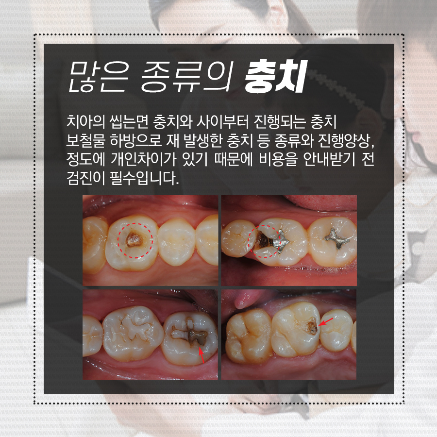 충치치료 비용이 왜 각각 다르고, 종류는 어떤 게 있을까? 관련 이미지 2