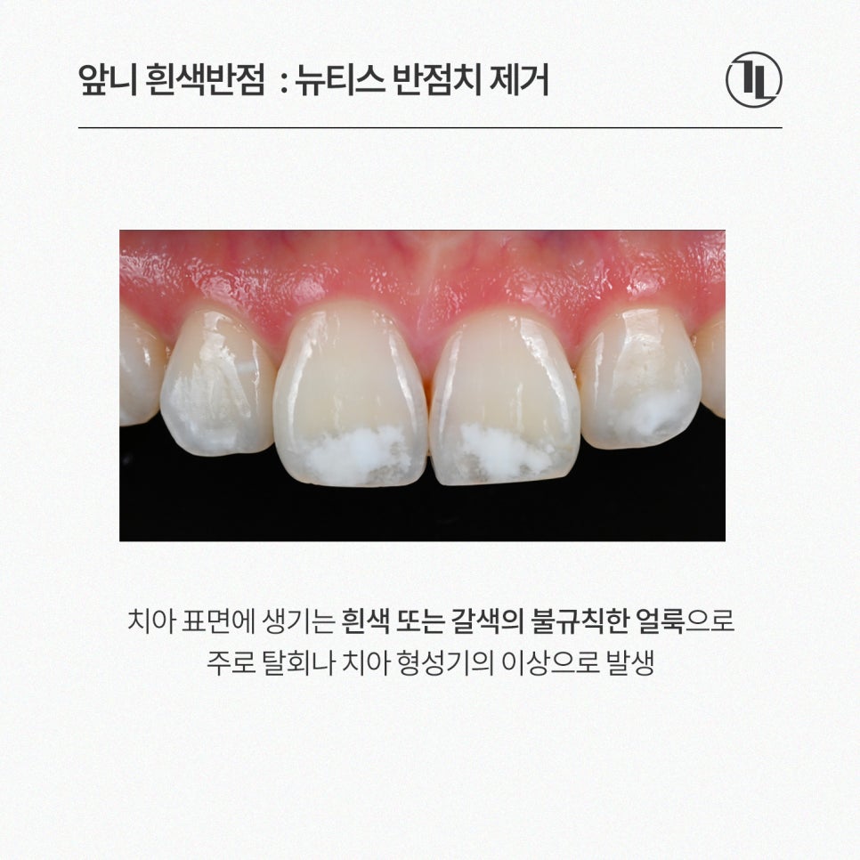 깨지고 하얗게 얼룩진 앞니, 라미네이트 대신 뉴티스 솔루션 / 강남레옹치과 관련 이미지 4