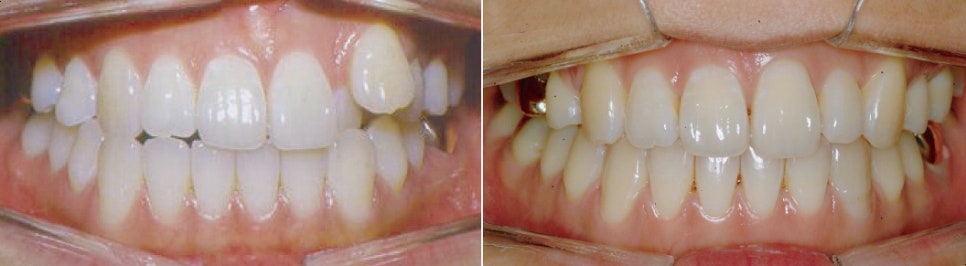 강남 치아교정치과 검증된 방법으로 만족도 업!! 관련 이미지 1