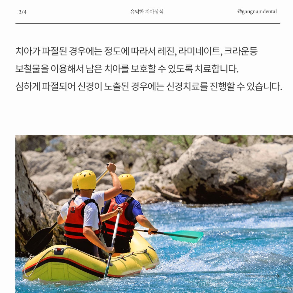 여름 휴가철, 안면외상 주의! 부딪혀서 앞니 흔들림 / 치아가 깨지거나 부러지면 제일 먼저 해야할 대처법은? / 치아 파절과 탈구 비교 관련 이미지 6