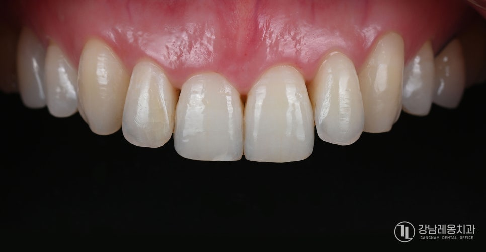 앞니 끝이 살짝 깨졌다면? 뉴티스 치아성형으로 자연스럽게 치아라인 정리하기 관련 이미지 5