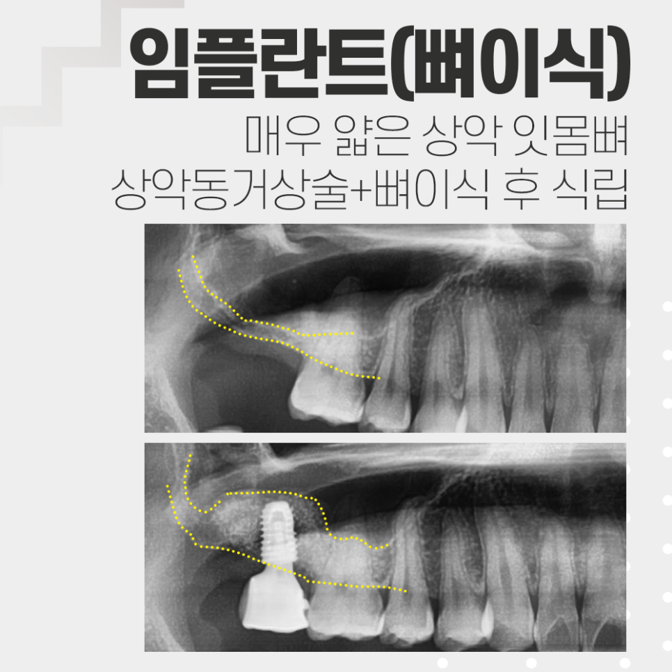 뼈가 얇아 상악동거상술과 뼈이식 후 임플란트 관련 이미지 1