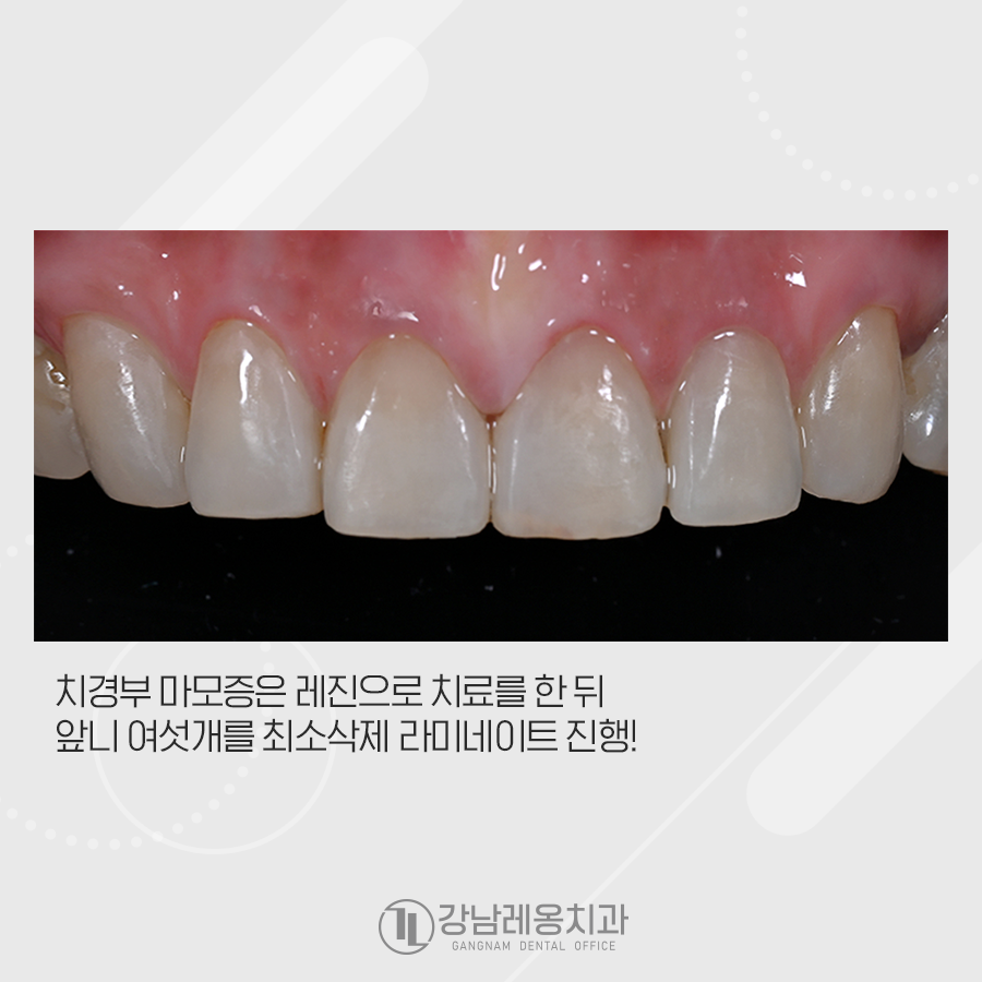 치경부마모증 때문에 시린이 레진 후 라미네이트 관련 이미지 2