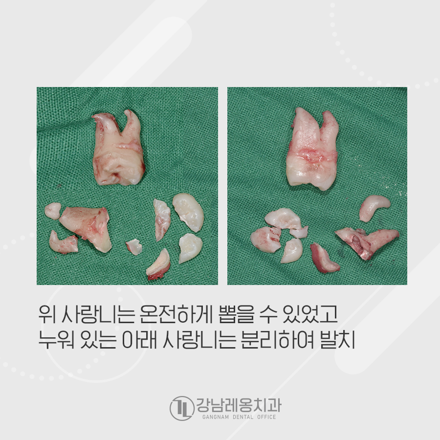 만곡치근? 뿌리가 휜 사랑니 4개 뽑아드린 발치 케이스 관련 이미지 3