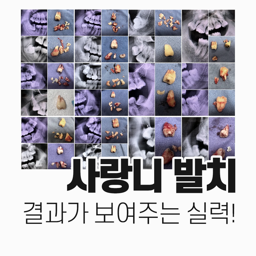 강남레옹치과 사랑니 발치, 결과가 증명해주는 실력! 관련 이미지 1