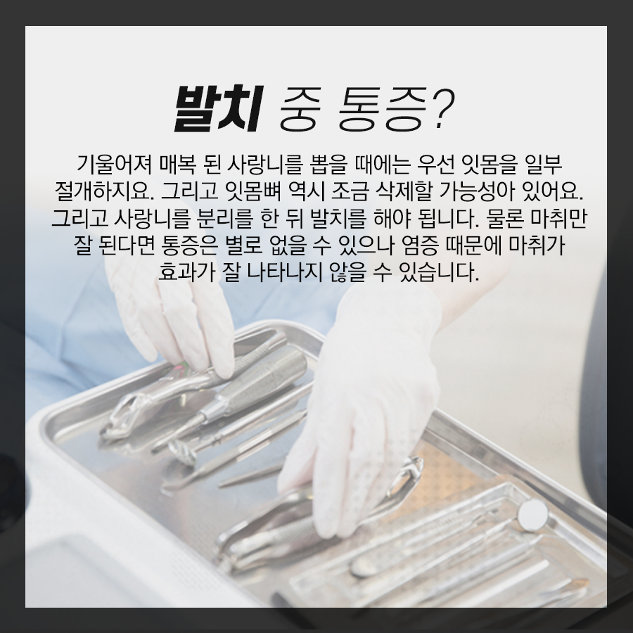 매복 된 누운 사랑니 발치를 하면 통증이 더 심할까? 관련 이미지 3