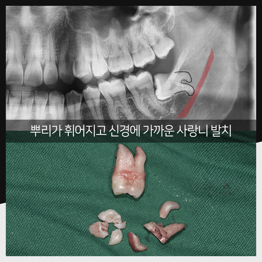 강남레옹치과 사랑니 발치, 결과가 증명해주는 실력! 관련 이미지 24