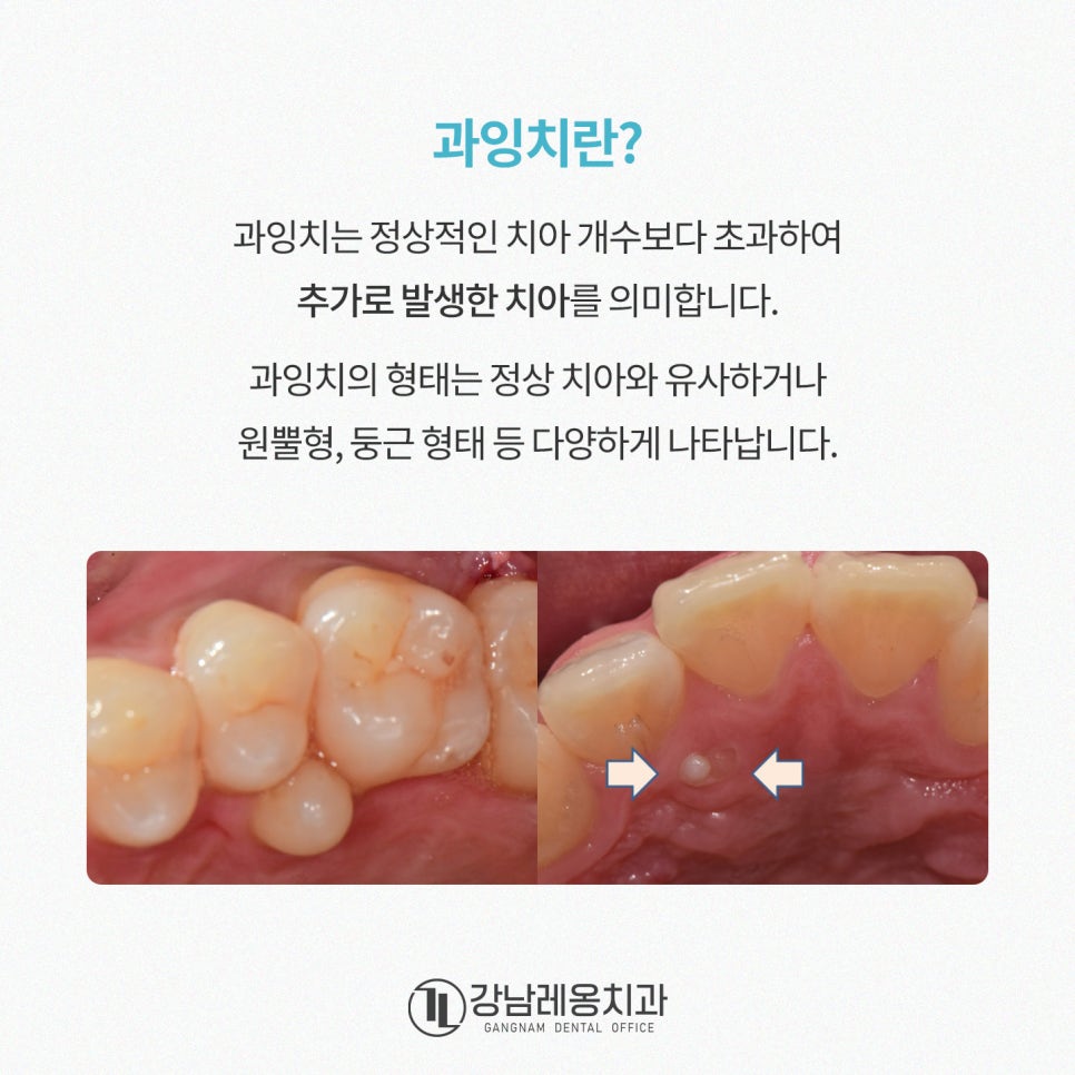 치아가 너무 많으면 생기는 일, 과잉치의 모든 것🦷 / 강남레옹치과 관련 이미지 2