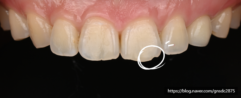 깨진 앞니 길이가 긴 앞니, 법랑질 성형 알아보기🔎 / 강남레옹치과의원 관련 이미지 3