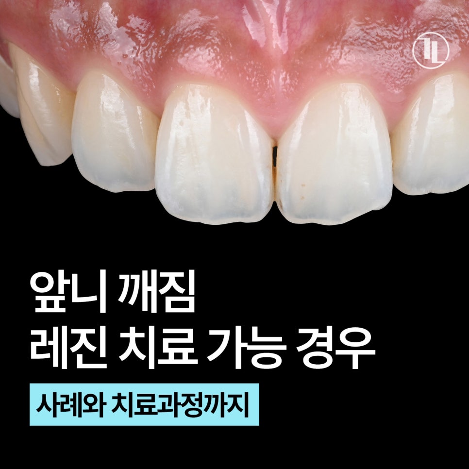 앞니 깨짐 레진치료 가능한 경우 / 레진치료 사례와 과정 / 강남레옹치과 관련 이미지 1