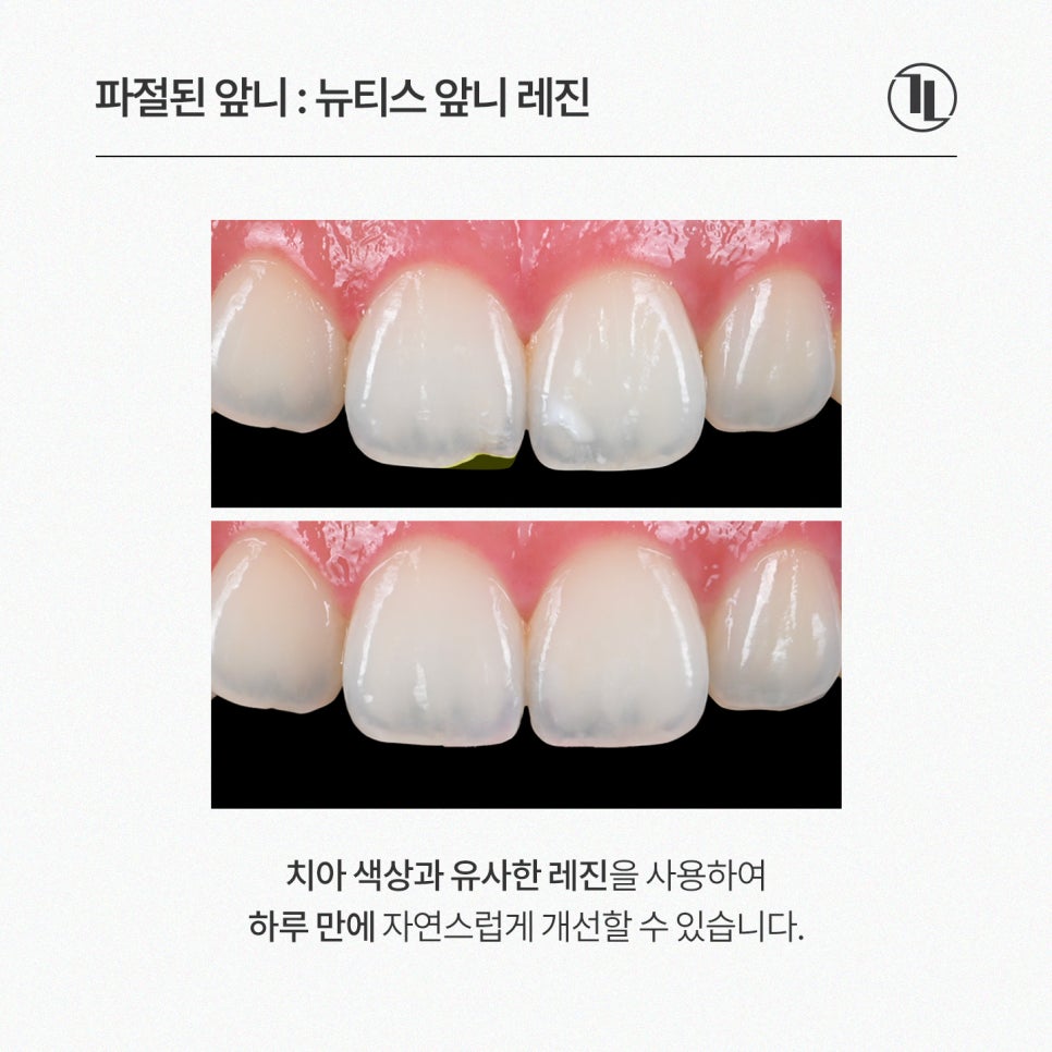 깨지고 하얗게 얼룩진 앞니, 라미네이트 대신 뉴티스 솔루션 / 강남레옹치과 관련 이미지 2