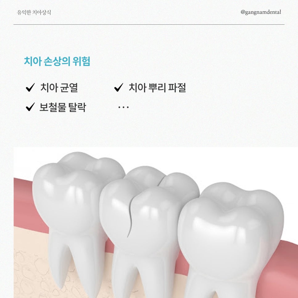 보철물탈락 대처방법은? / 추석명절 생긴 치아 문제, 계속 방치하지 마세요! / 강남레옹치과 관련 이미지 2