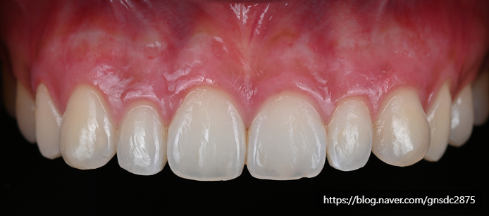 잇몸도 화이트닝이 된다? 까만 잇몸, 착색 잇몸 미백 / 강남레옹치과 관련 이미지 6