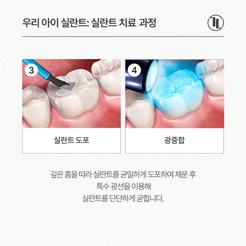 어린이 실란트, 언제 해야 할까? 시기와 보험 혜택까지 쉽게 설명 / 강남레옹치과 관련 이미지 6