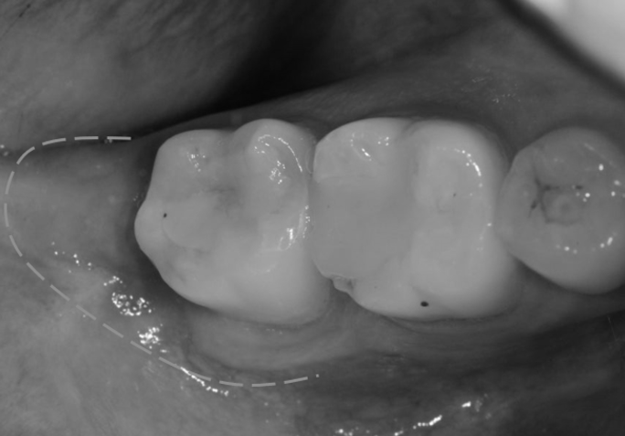 사랑니 발치 후 구멍, 음식물 끼임부터 회복, 관리법까지 총정리📑 / 강남레옹치과 관련 이미지 6