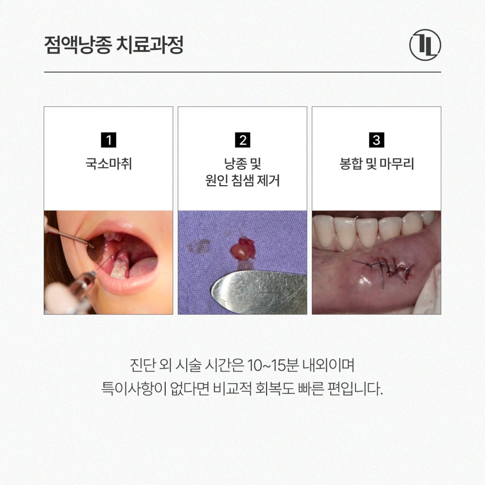 입술 안쪽에 말랑한 멍울, 그냥 둬도 괜찮을까? / 점액낭종 특징과 치료 / 강남레옹치과 관련 이미지 5