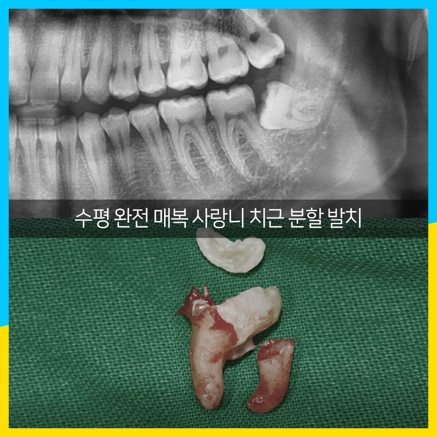 사랑니 발치 뿌리가 휘어졌는데도?? 관련 이미지 3