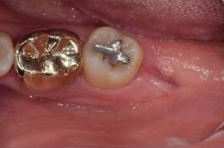 사랑니 발치 후 회복과정 한 눈에 보기🔍 / 강남역 사랑니 강남레옹치과 관련 이미지 12