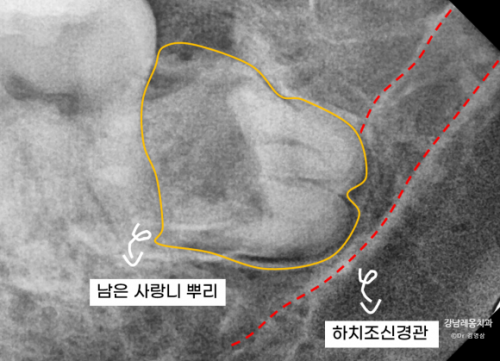 뿌리를 남긴 사랑니 발치? / 강남역 사랑니발치 강남레옹치과 관련 이미지 4