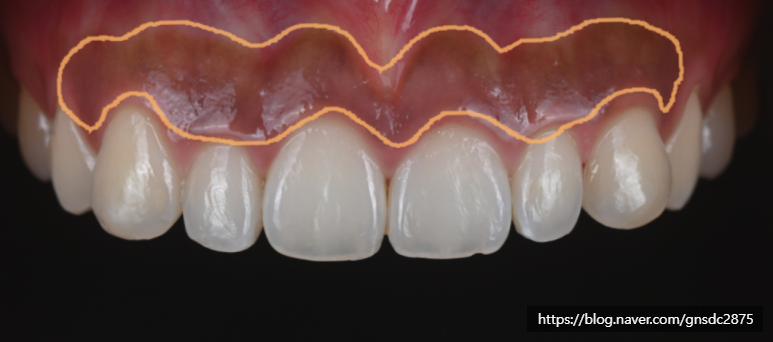잇몸도 화이트닝이 된다? 까만 잇몸, 착색 잇몸 미백 / 강남레옹치과 관련 이미지 5
