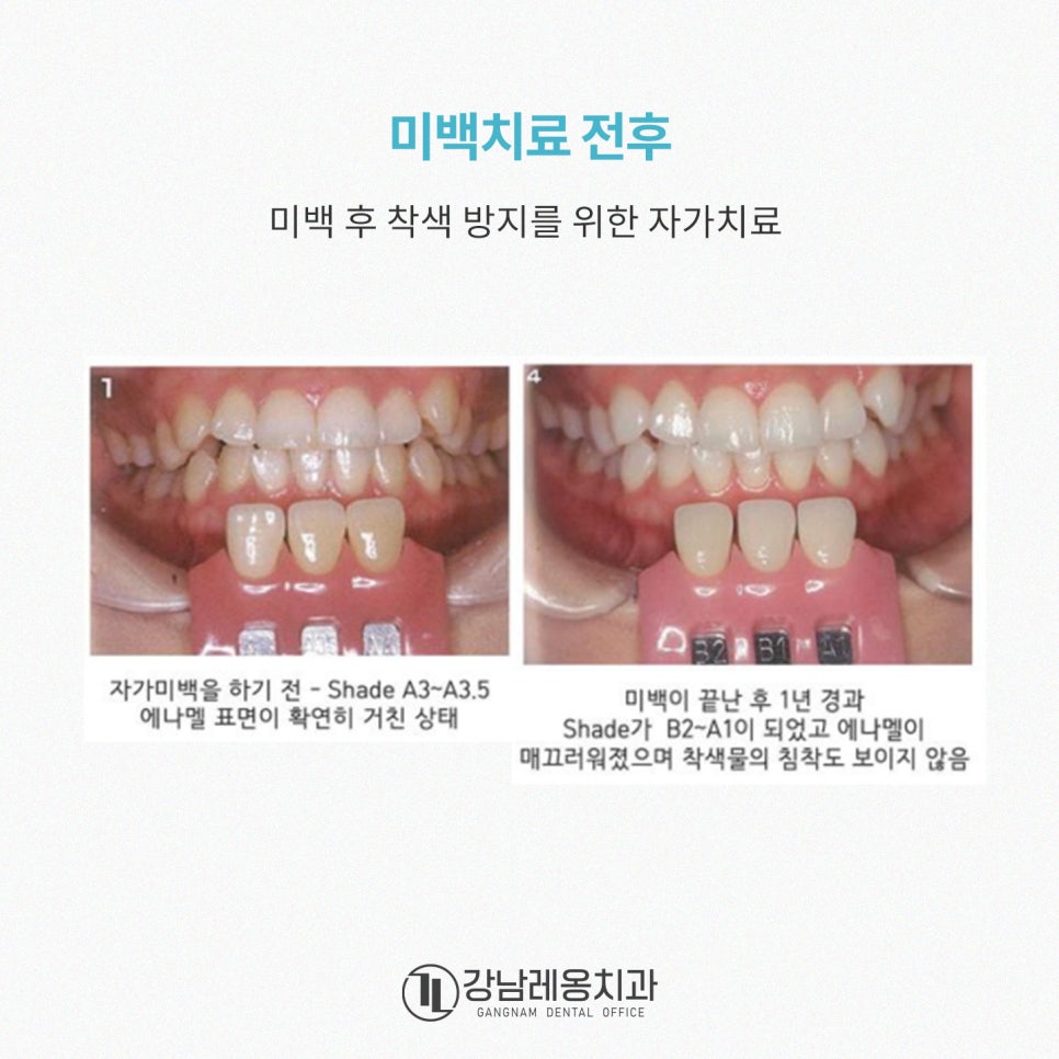 충치예방부터 시린이 완화까지! 아파프로 치아영양제의 5가지 효과✨ / 강남레옹치과 관련 이미지 11