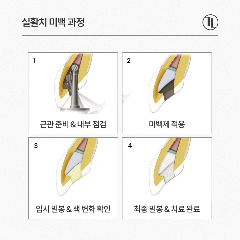앞니 하나가 어두워졌다? / 앞니 변색 원인과 실활치 미백 과정 / 강남레옹치과 관련 이미지 4