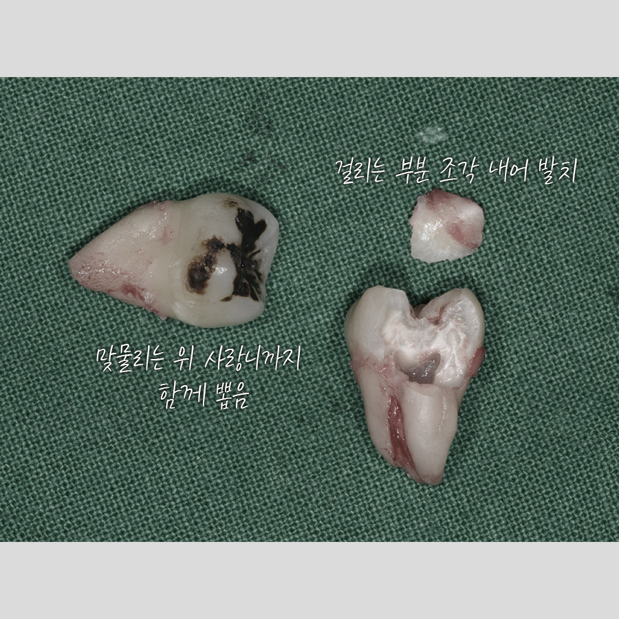 사랑니 발치 전문 레옹의 치료사례, 신경이 가깝거나 멀거나 관련 이미지 5