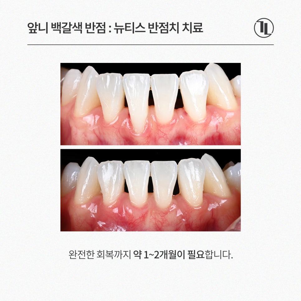 잇몸 내려앉음, 잇몸퇴축 잇몸이식으로 개선 / 강남레옹치과 관련 이미지 5