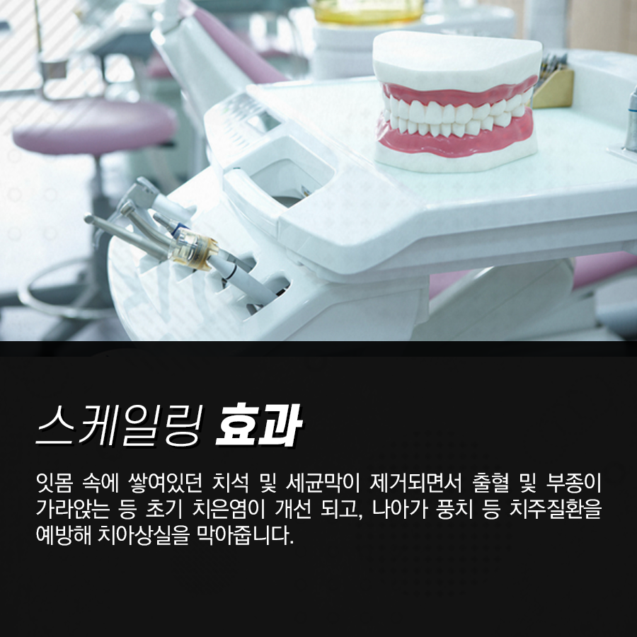 건강보험 적용 되는 치아 스케일링 효과 알고 받으면 더 좋아요! 관련 이미지 4