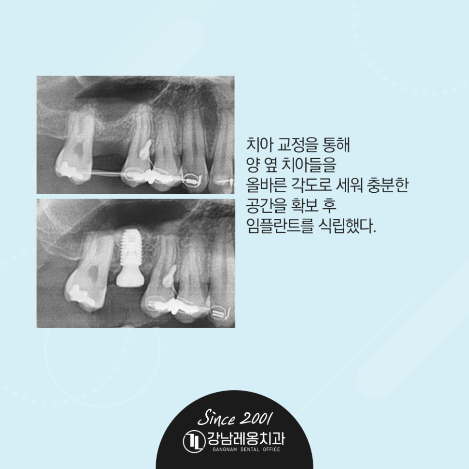 옆 치아 쓰러져 좁아진 공간, 강남레옹치과 임플란트 수술 증례 관련 이미지 3