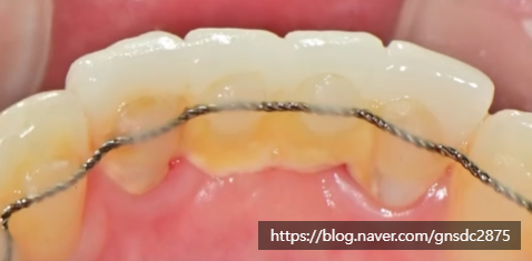 겨울철 구강관리, 스케일링 한 번으로 바뀌는 잇몸 상태❄️ / 강남레옹치과 관련 이미지 7