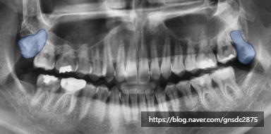 아래 사랑니만 발치해도 괜찮을까? 강남역 사랑니발치 /  강남레옹치과 관련 이미지 4