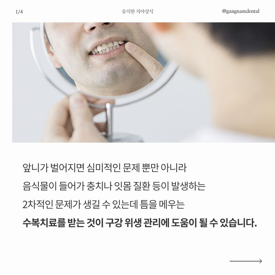 치아 벌어짐 / 앞니 사이 간격 넓어짐 / 정중이개 원인의 증상 그리고 개선할 수 있는 방법에 대해 관련 이미지 2