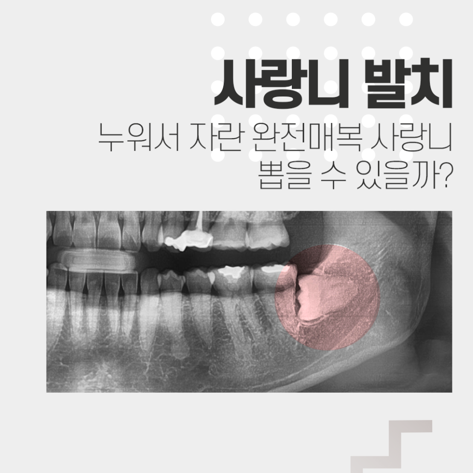 누운 사랑니 전문 치과! 수평 매복 분리해서 빠르게 발치~! 관련 이미지 1