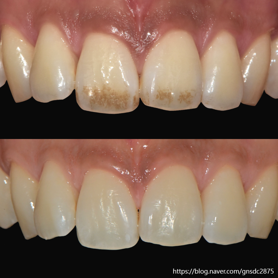 커피&middot;담배치아 착색! 에어플로우로 제거⚡ / 강남레옹치과 관련 이미지 4