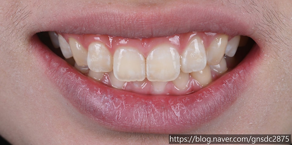 앞니 하얀얼룩 아이콘레진으로 말끔하게 / 뉴티스 반점치치료 / 강남레옹치과 관련 이미지 7