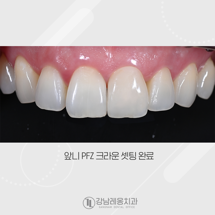 오래된 레진 변색, 강남레옹치과에서 앞니 크라운 치료 관련 이미지 3
