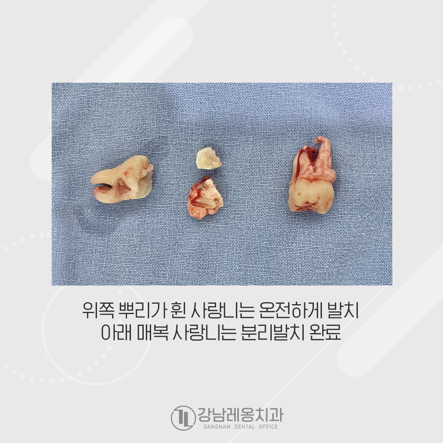매복 사랑니 뿌리 신경이랑 겹쳐있고 염증까지? 관련 이미지 3