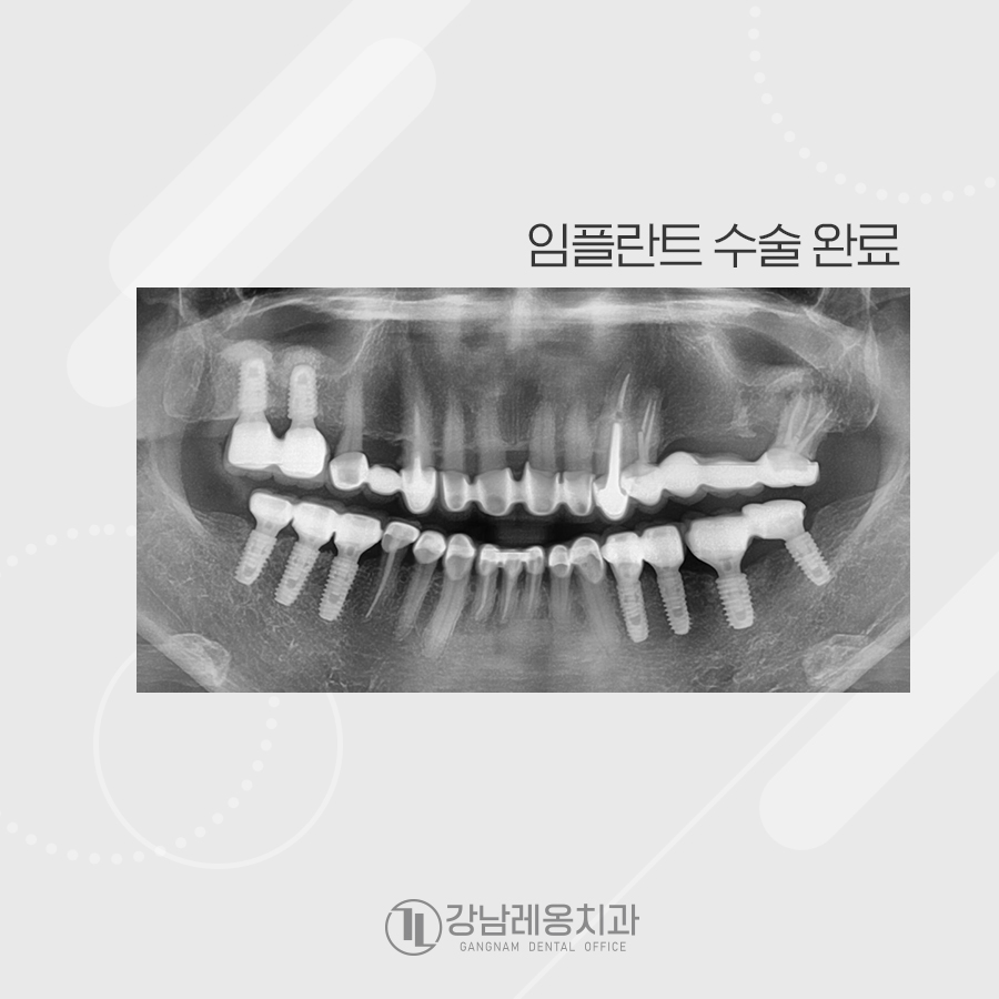 멀쩡한 줄 알았던 오래된 브릿지, 임플란트 수술한 사연 관련 이미지 5