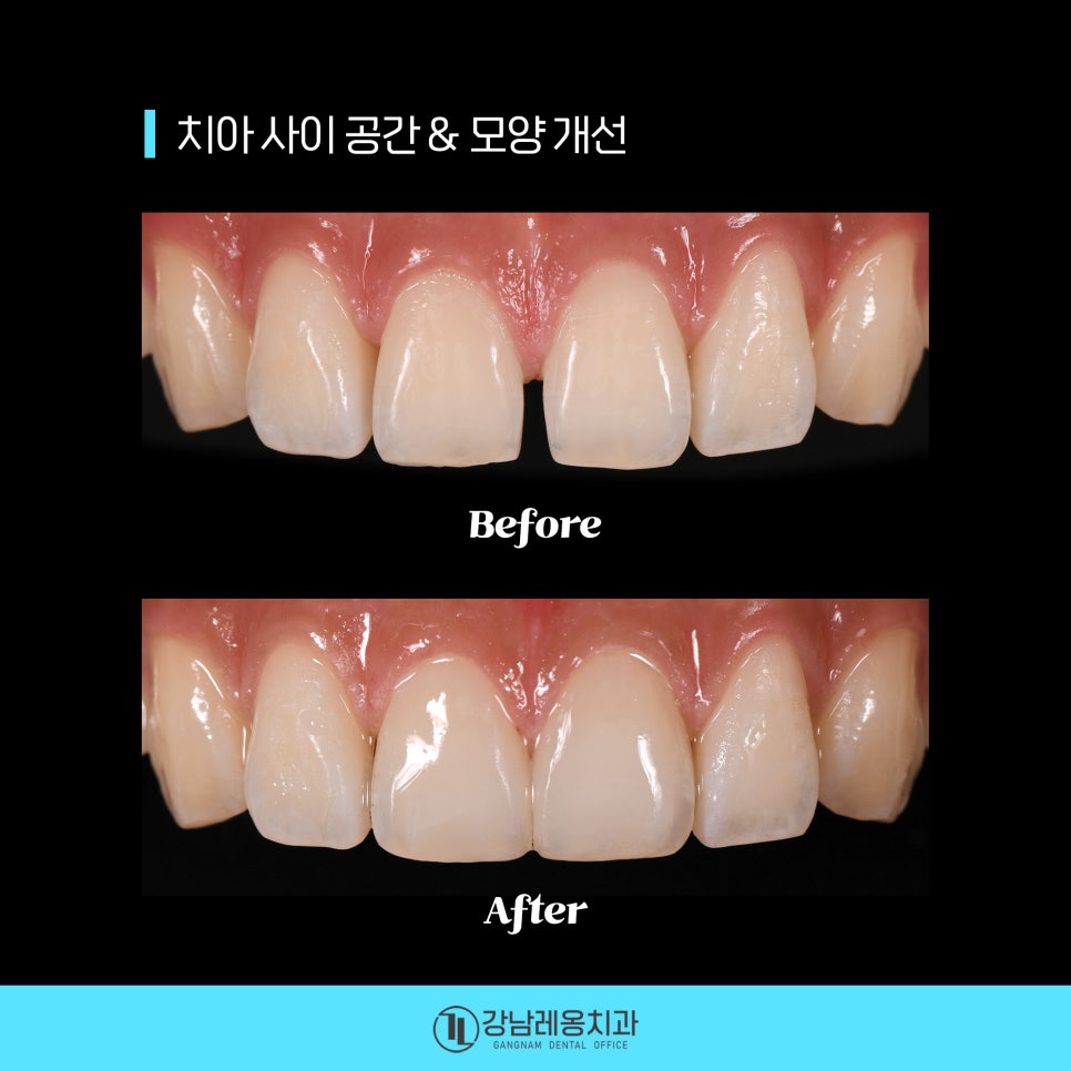 최소삭제 라미네이트 &lsquo;뉴티스&rsquo;의 시술 후 관리방법은? / 양치질, 치실 사용방법 / 강남레옹치과 관련 이미지 5