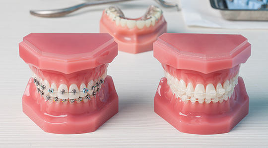 치아에 흰 반점? 화이트스팟 예방법과 치료 방법, 아이콘레진 / 강남레옹치과 관련 이미지 3