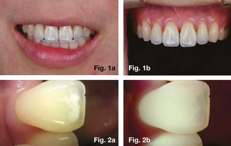 에나멜 손상 진단 및 치료에 사용되는 관련 이미지 4