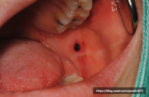 아래 사랑니만 발치해도 괜찮을까? 강남역 사랑니발치 /  강남레옹치과 관련 이미지 5