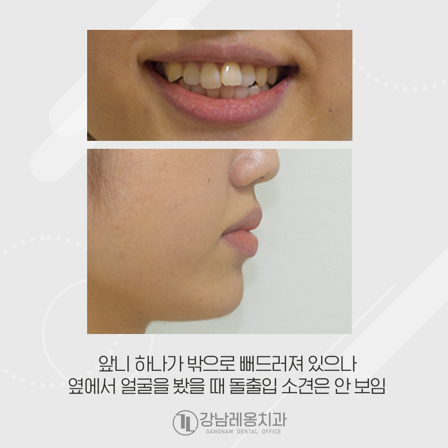 삐뚤빼뚤 앞니 비발치 교정, 옥니가 되지 않게 관련 이미지 3