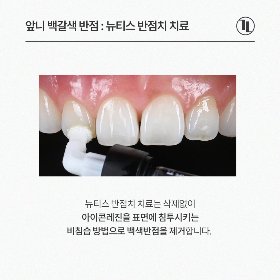 앞니 하얀점, 뉴티스 반점치 제거로 당일 개선 / 강남레옹치과 관련 이미지 4