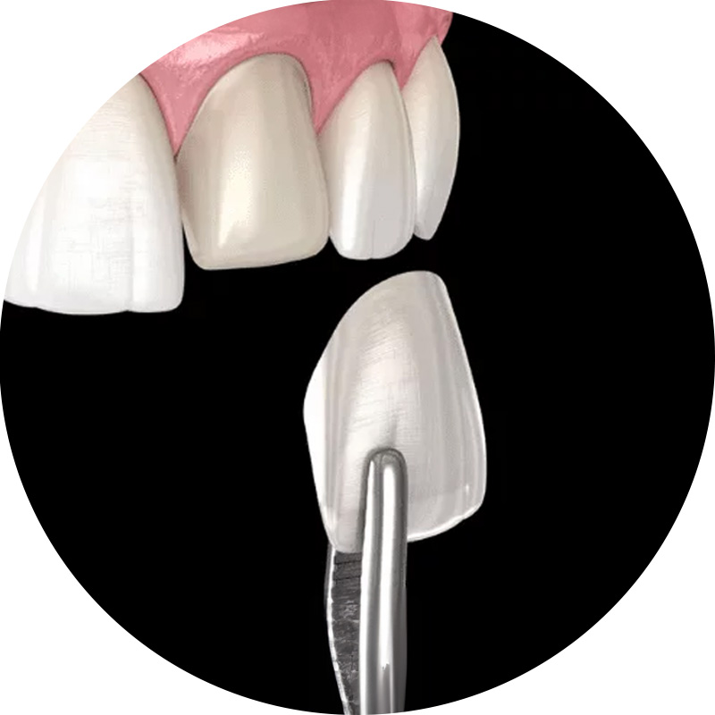 앞니 벌어짐 치료 후기 / 아이 앞니 벌어짐 건강하게 치료하려면? / 강남레옹치과 관련 이미지 7