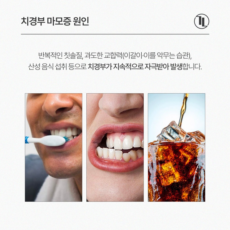 Tooth Notches and Tooth Sensitivity? Cervical Abrasion / Comparing Causes and Treatment Methods / Gangnam Leon Dental Clinic image 3