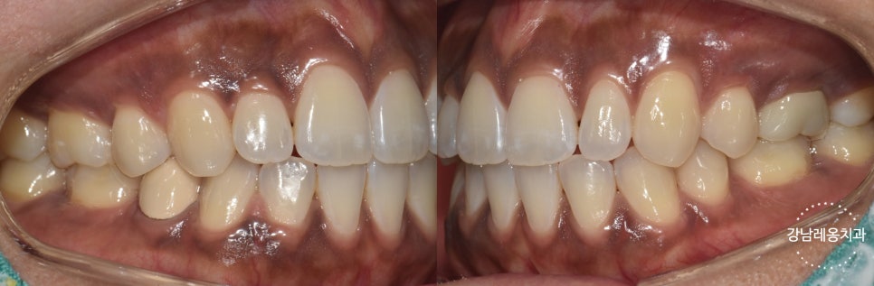 잇몸미백 효과 있나요? 시술 전후와 유지기간, 부작용까지!  / 강남레옹치과 뉴티스 잇몸미백 관련 이미지 6