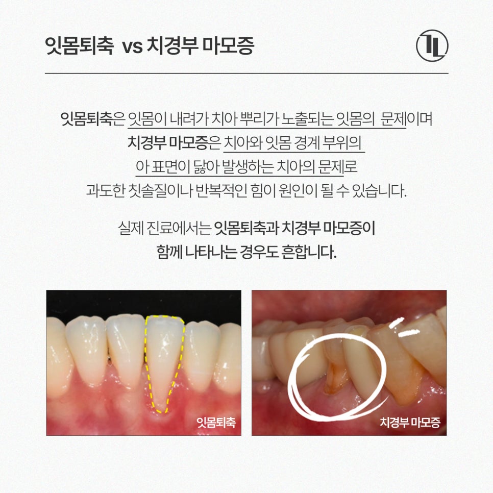 Receding Gums and Tooth Sensitivity, Gum Recession / A Complete Guide from Causes to Treatment / Gangnam Leon Dental Clinic image 4