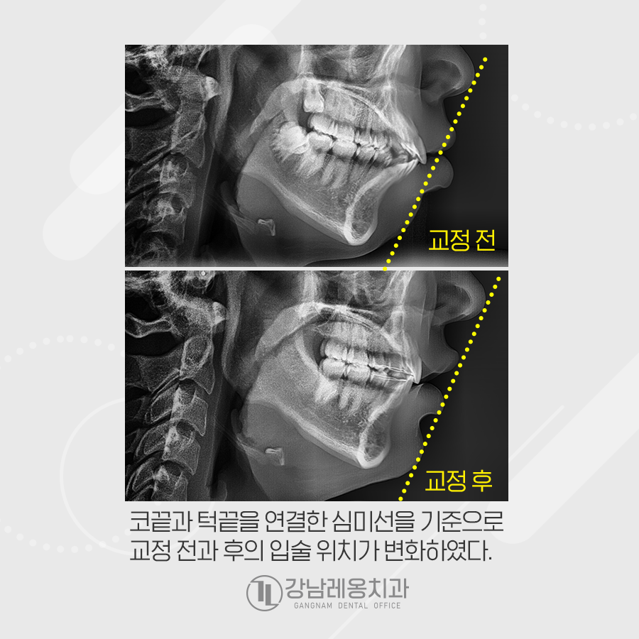 돌출입, 치아교정으로 심미라인에 맞춰 예쁘게 완성 관련 이미지 2